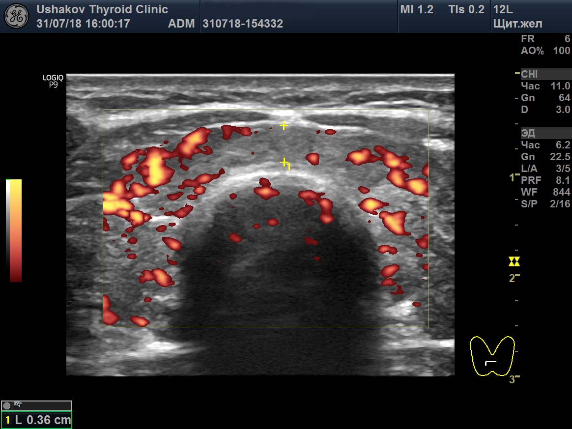 узи щитовидки минск. цдк в узи что это. узи щитовидки минск. ультразвуковое исследование щитовидной железы. узи щитовидки минск.