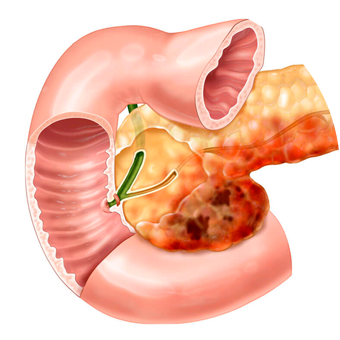 Панкреатит при удаленном желчном пузыре
