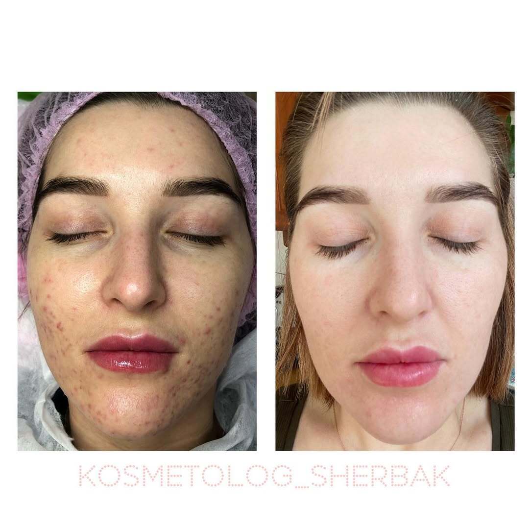 Лечение акне у женщины в клинике PradusCOSMO, СПб. До и после процедуры