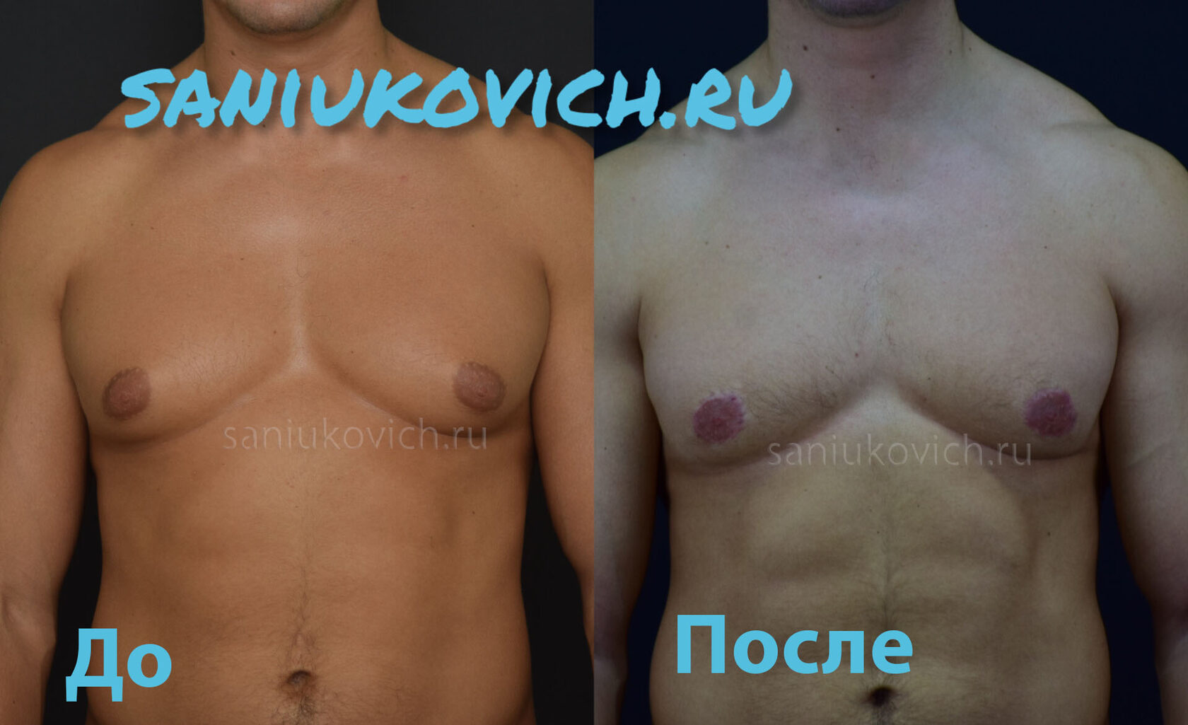 гормоны которые увеличивают грудь у мужчин фото 24