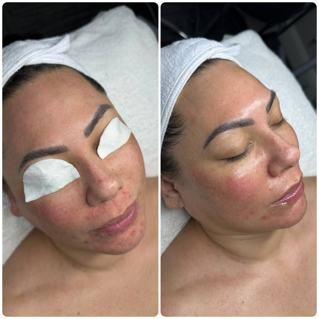 HydroDermabrasion before and after clear pores radiant skin Beauty Studio by Hanna Mount Pleasant SC