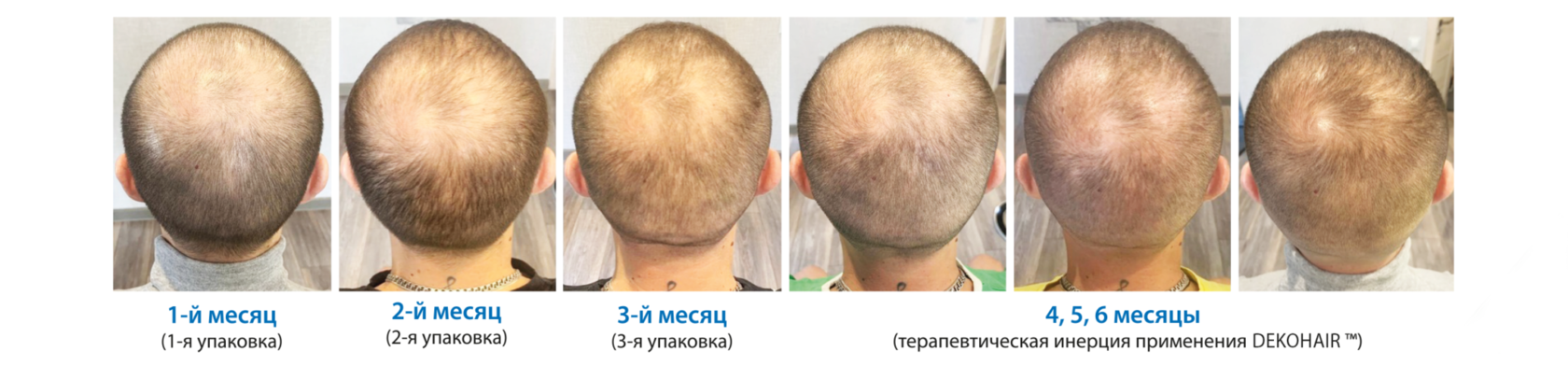 Волосы алопеция до после. Deko hair лосьон для роста волос. Лосьон от алопеции. Андрогенетическая алопеция у мужчин.