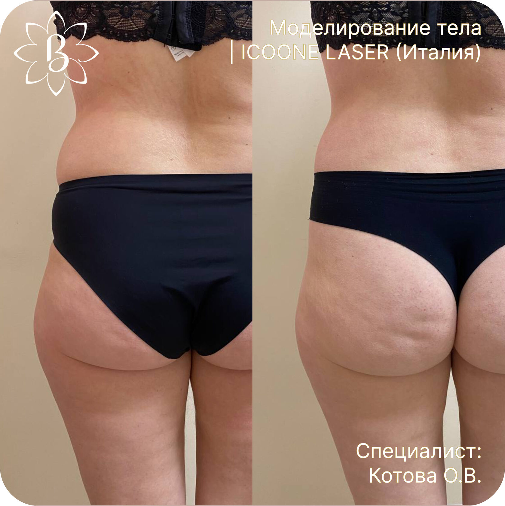 Диодная лазерная эпиляция