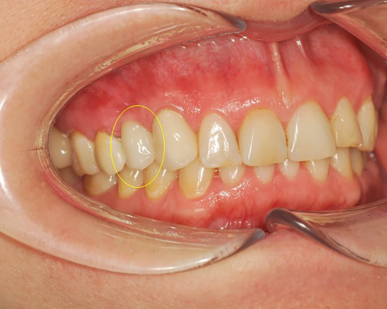 Одномоментная имплантация при переломе корня зуба 
