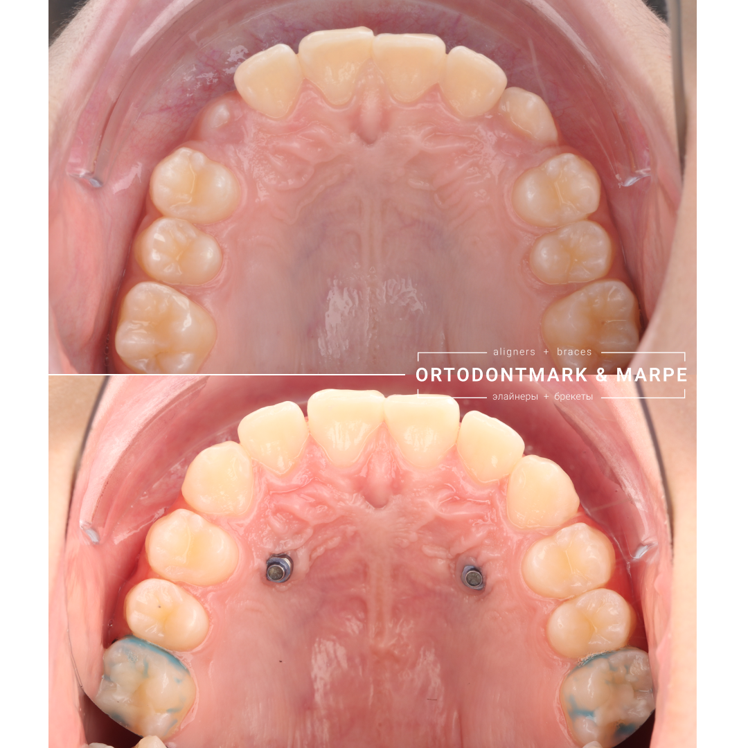 MARPE case result 6