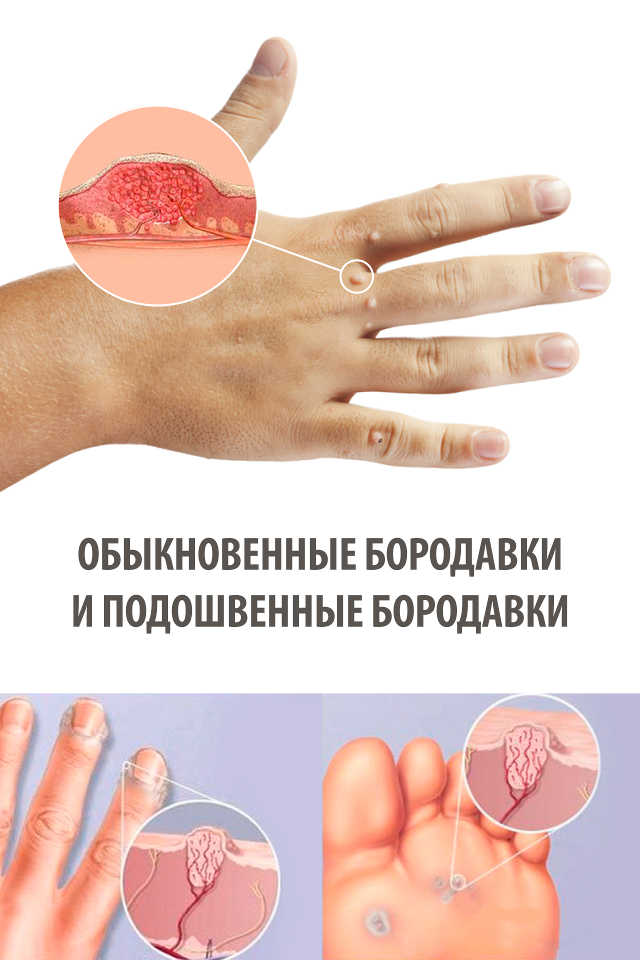 Вартокс® крем-паста от подошвенных бородавок. Официальный сайт