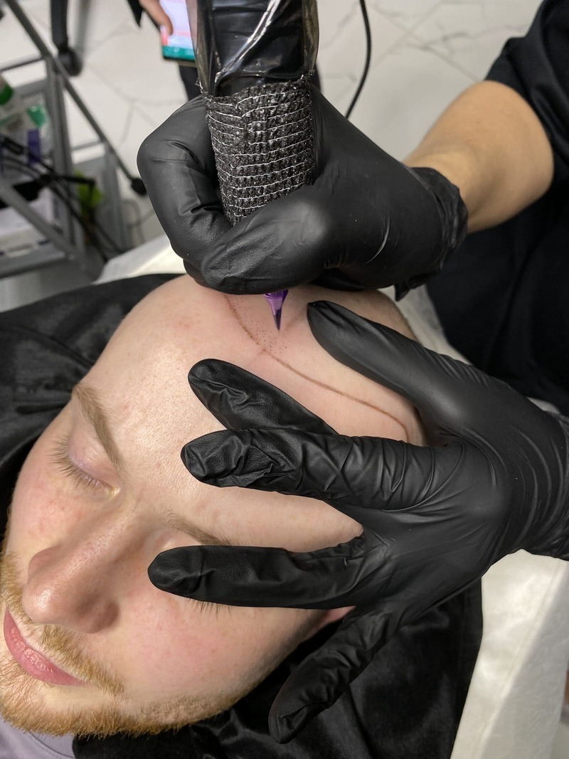 Процедура трихопигментации SMP алопеция