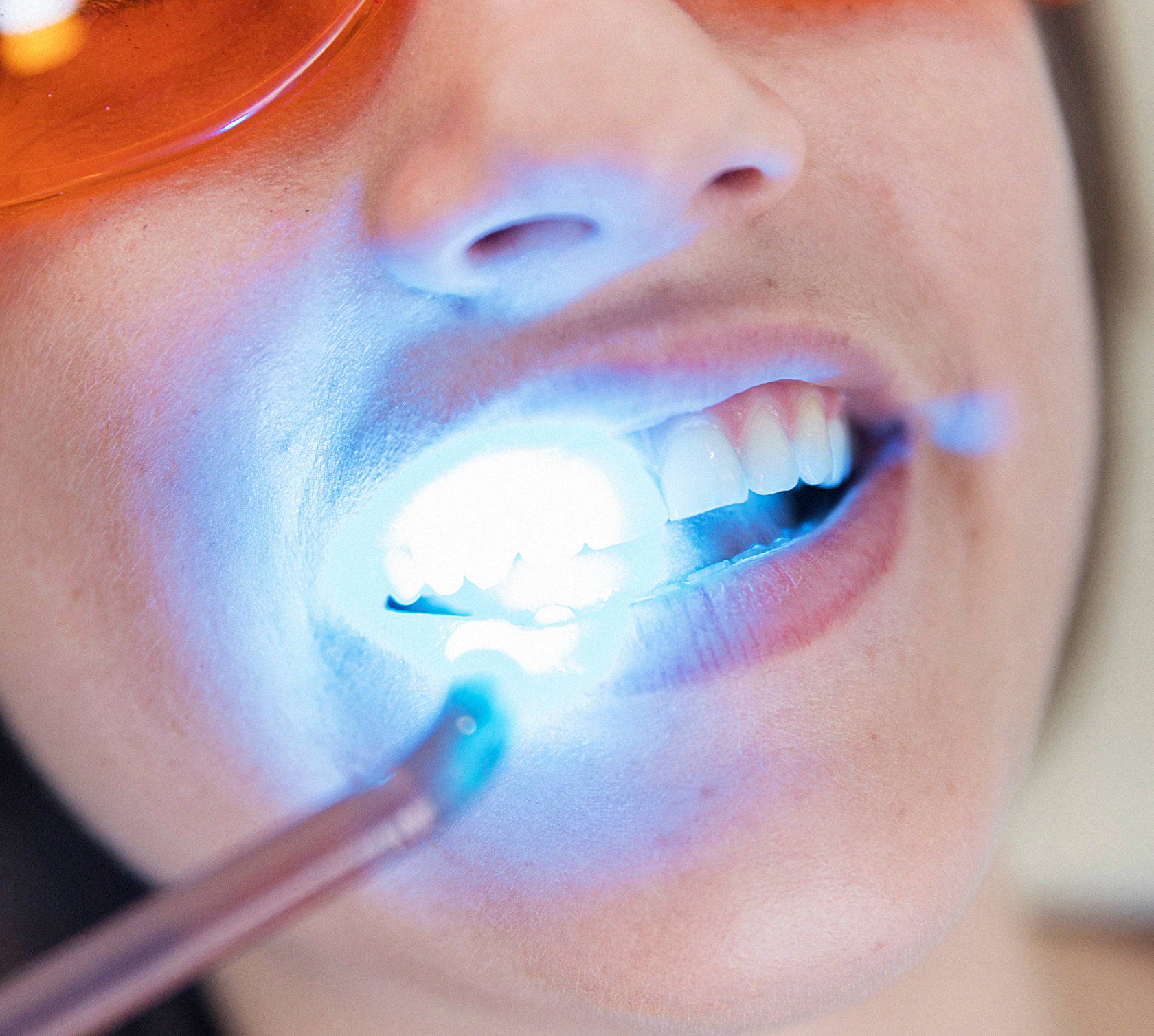 Способы отбеливания зубов у стоматолога