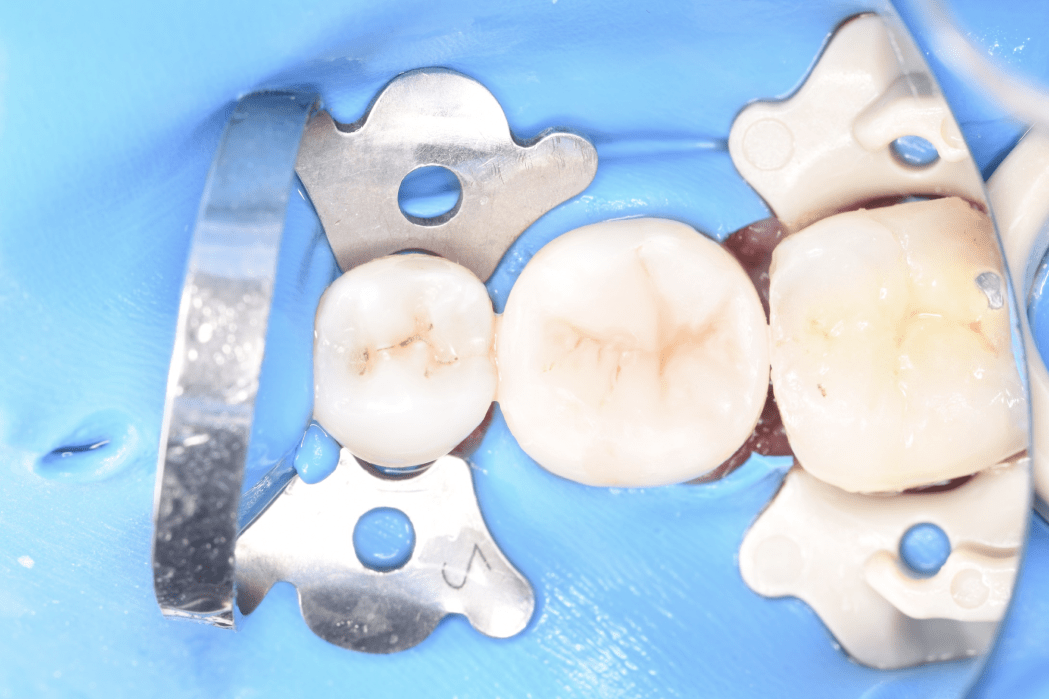 Лечение кариеса зуба - стоматология на Мичуринском проспекте