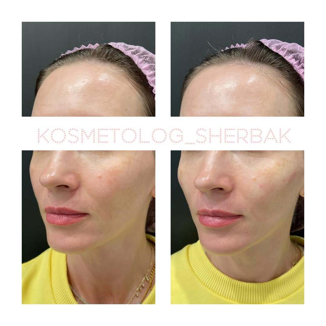 Контурная пластика лица в клинике PradusCOSMO, Санкт-Петербург. Естественный результат без эффекта переделанного лица