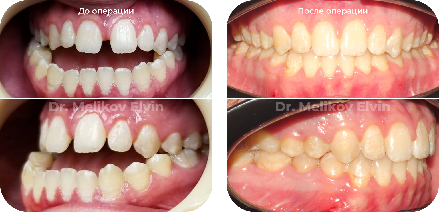 Фотографии прикуса до и после ортогнатической операции.