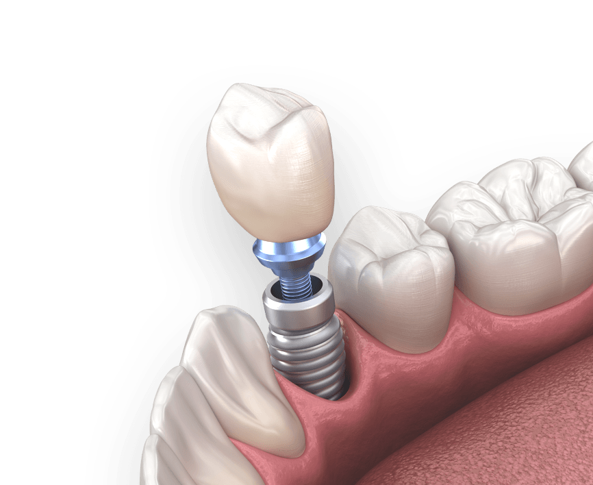 Как Выглядит Имплант Зуба Фото – Telegraph