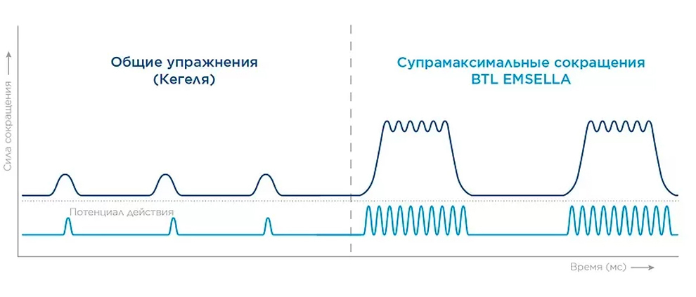 Противопоказания кресло btl emsella