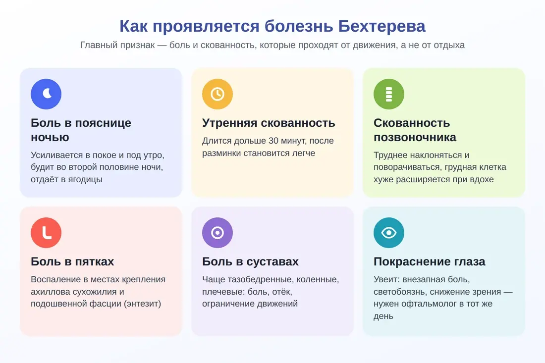 Симптомы болезни Бехтерева: ночная боль в пояснице, утренняя скованность, боль в пятках, суставах, покраснение глаза