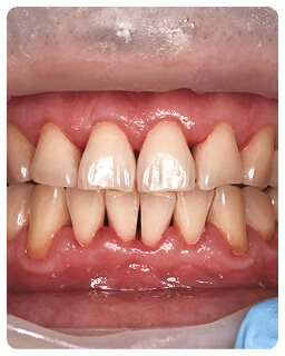 Чистка зубов в Луганске, в стоматологии Дент-Арт