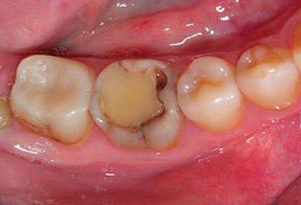 Причины возникновения ноющей зубной боли
