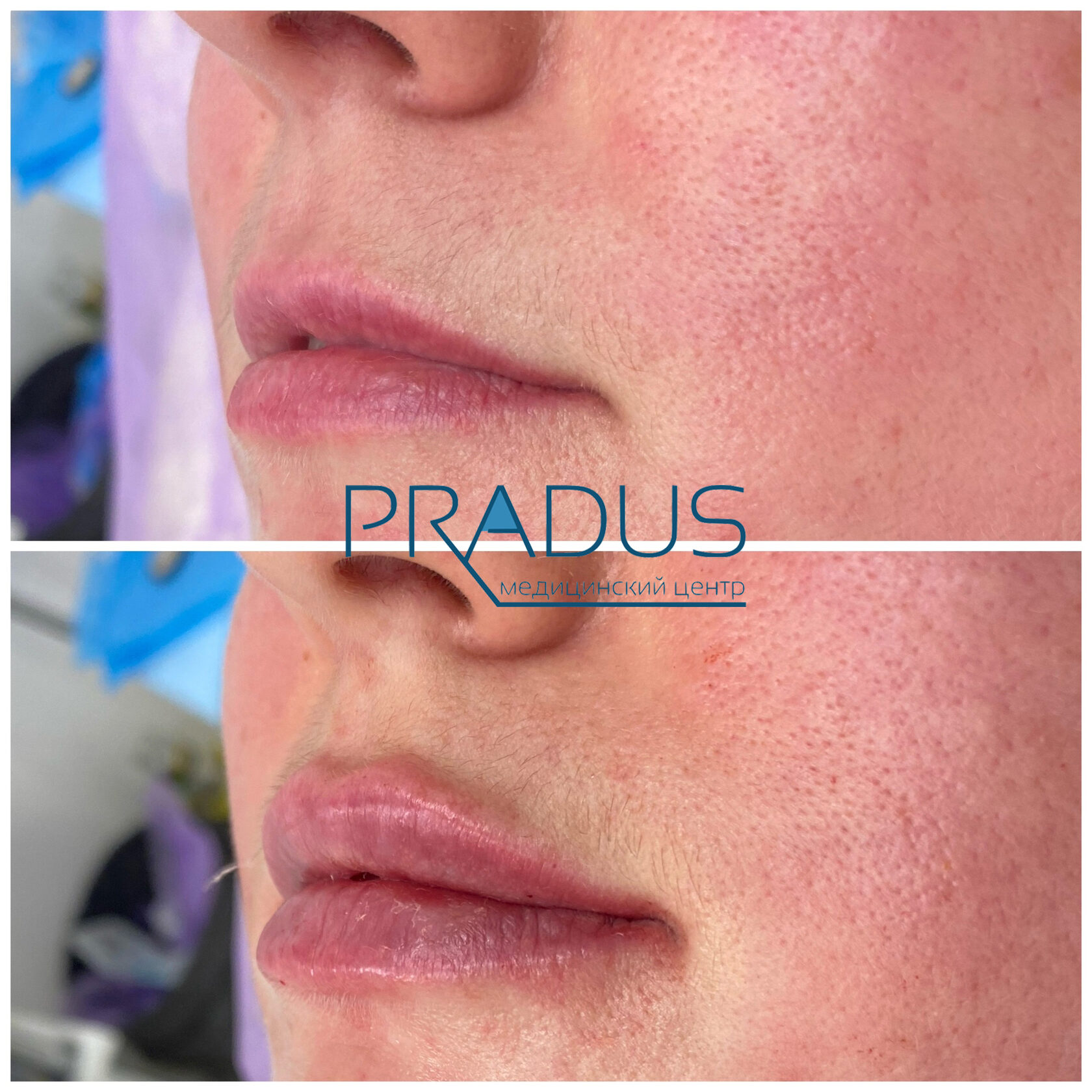 До и после контурной пластики губ. Увеличение объёма без утяжеления. PradusCOSMO, Васильевский остров