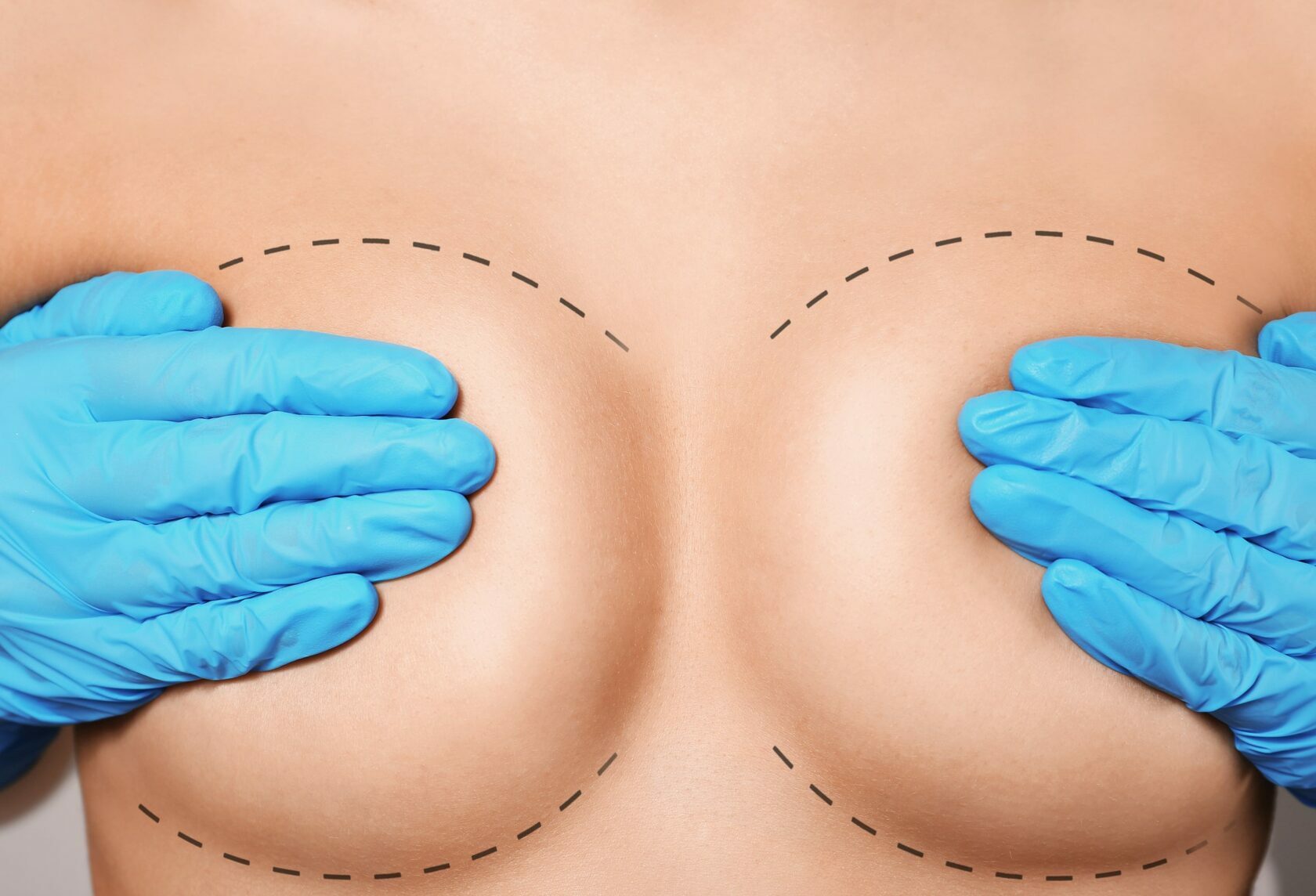 как делают пластическую операцию груди женщин фото 60
