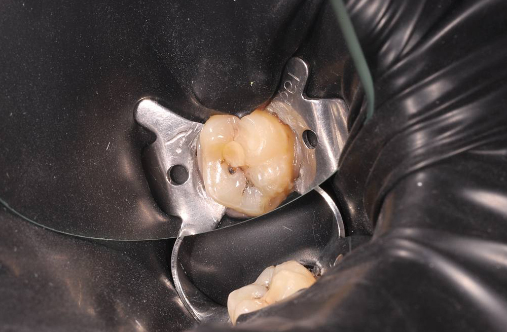 Устранение температурной чувствительности зуба и его функциональное восстановление современными материалами