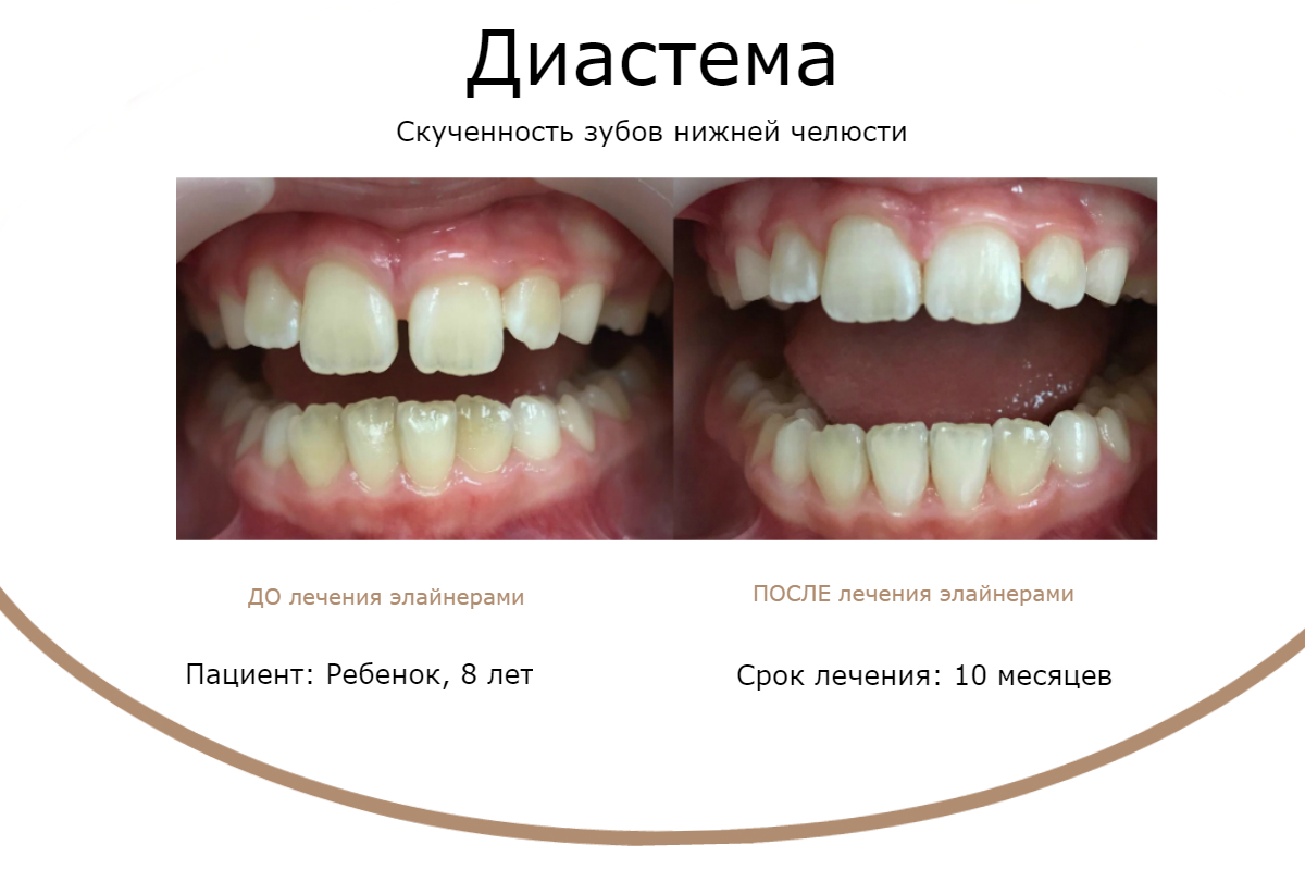 Элайнеры отзывы