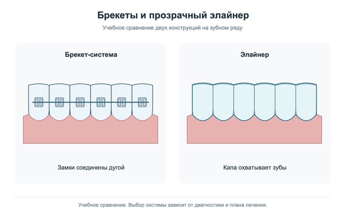 Брекеты и элайнер на учебных моделях зубов