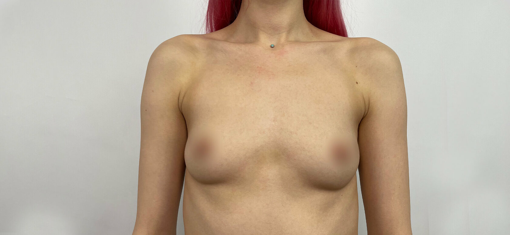 может ли при мастопатии увеличиться только одна грудь фото 91