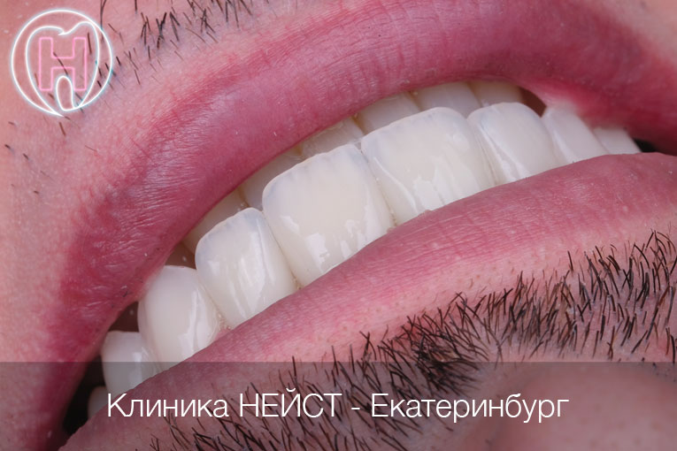 Мужские керамические виниры цвет Блич 4 (Bleach 4)