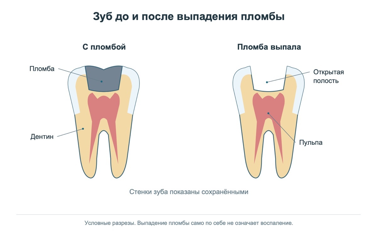 Дефект зуба после выпадения постоянной пломбы