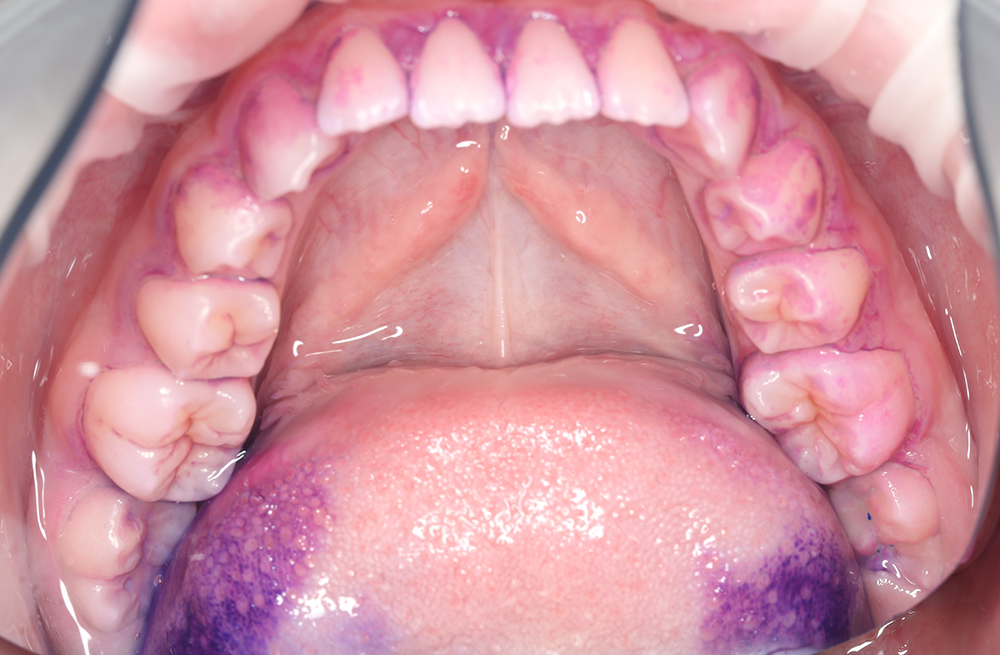 Профессиональная чистка зубов Air Flow с диагностикой и планированием лечения кариеса