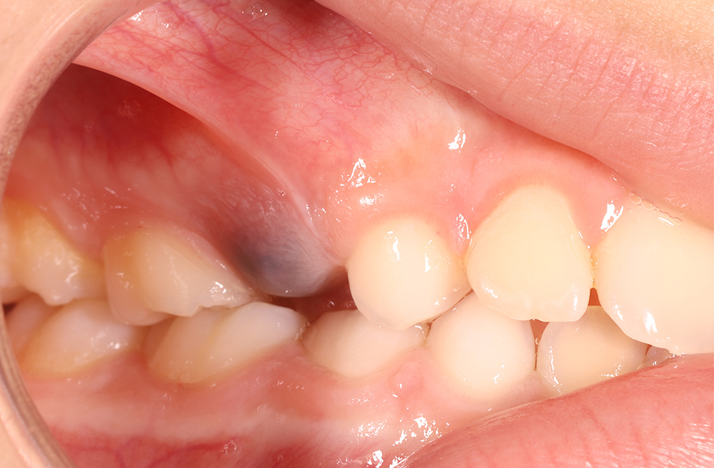 Гематома на десне при прорезывании зуба у ребенка