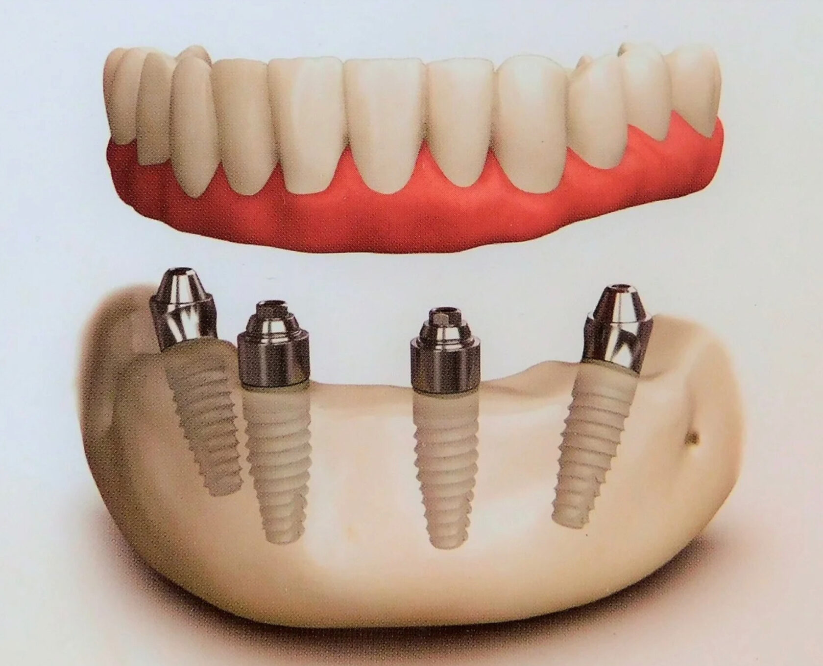 Несъемный зубной протез на 4 имплантах цена