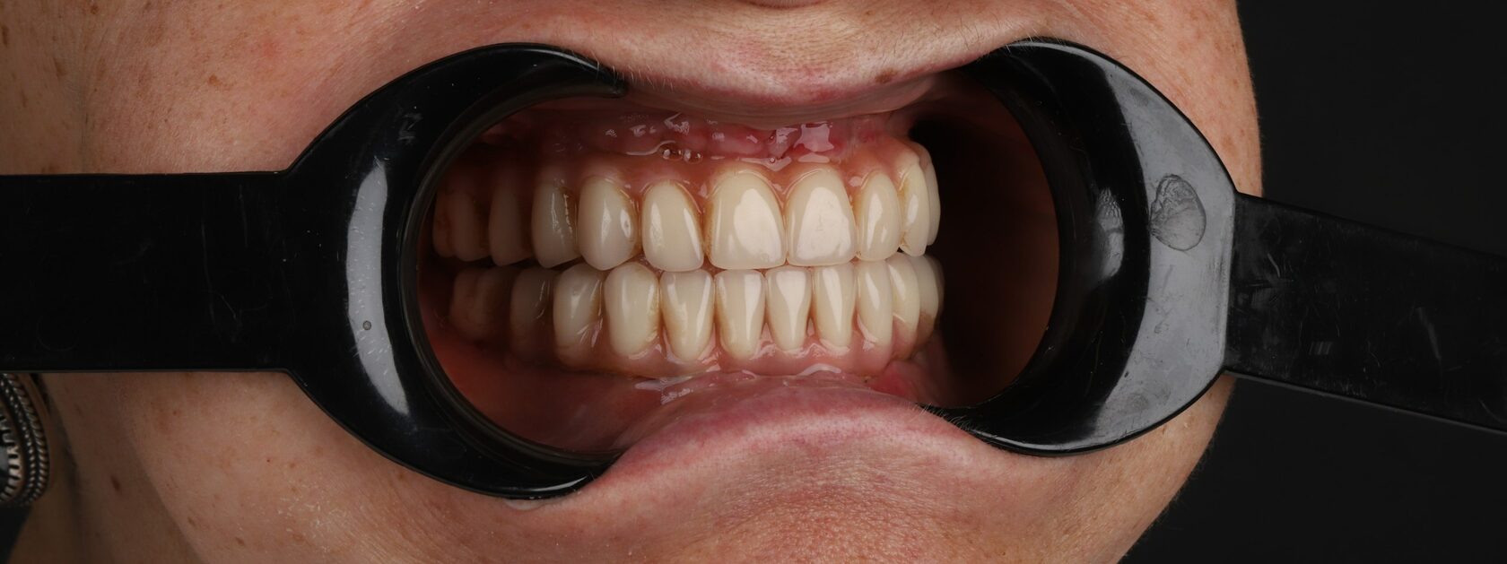 All-on-4, All-in-4 имплантация, протезирование, вернуть зубы, протезирование на имплантах, всё-на-4, все-на-четырех, протезирование зубов