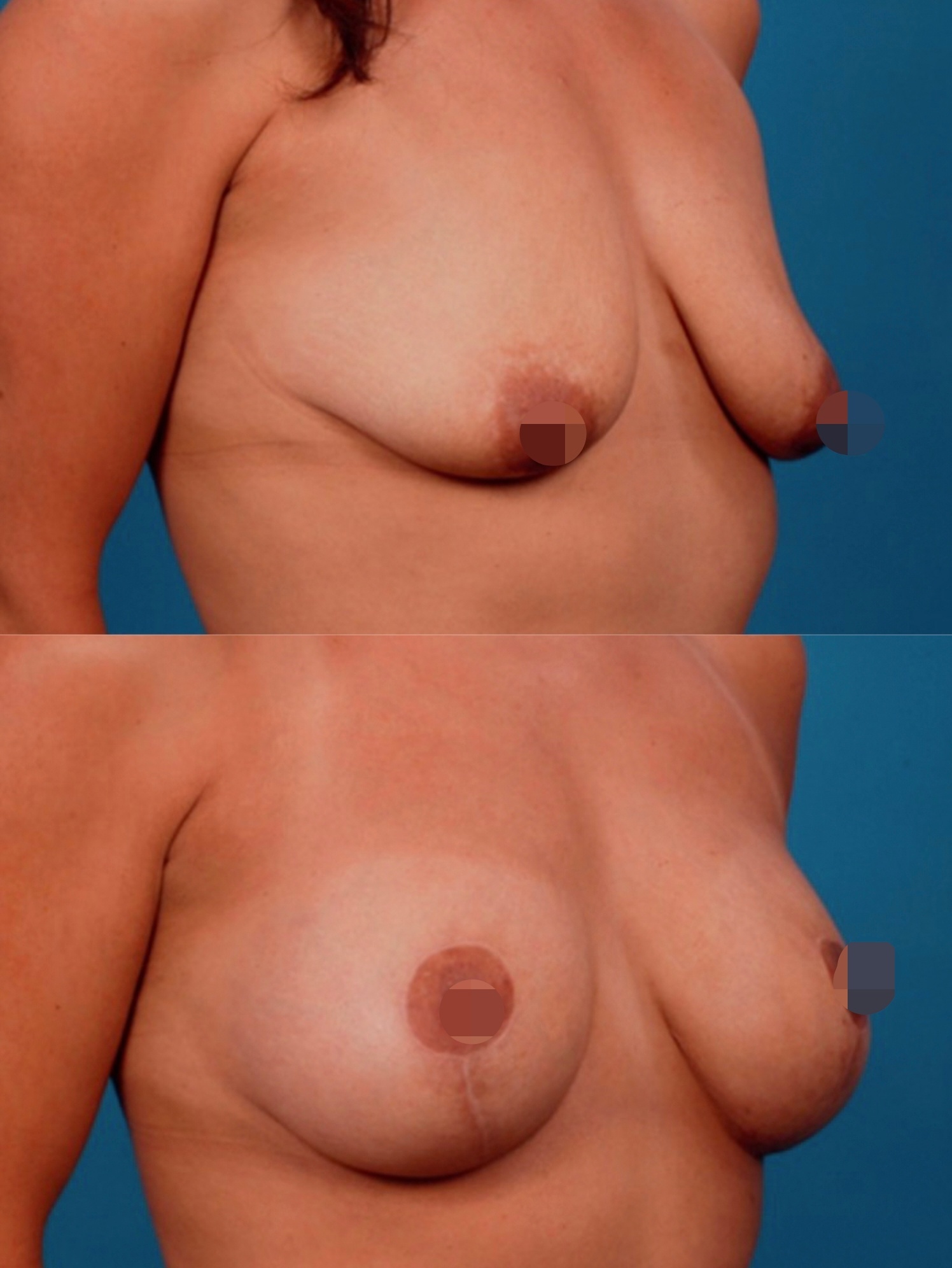 отзывы женщин о подтяжке груди фото 8