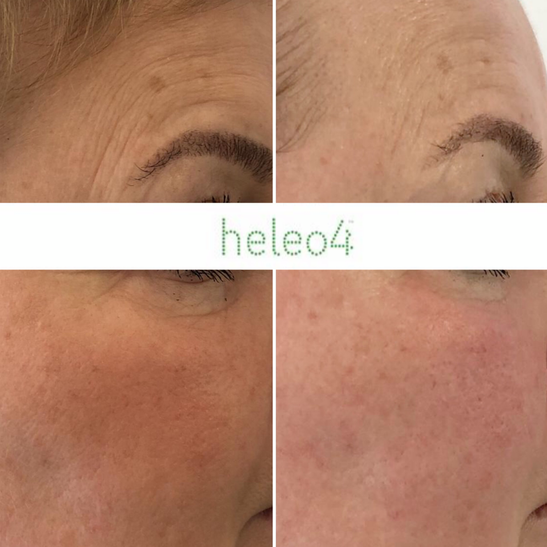 Heleo. Heleo4 аппарат. ФДТ heleo4. Гелио 4 фотодинамическая терапия. ФДТ аппарат REVIXAN.