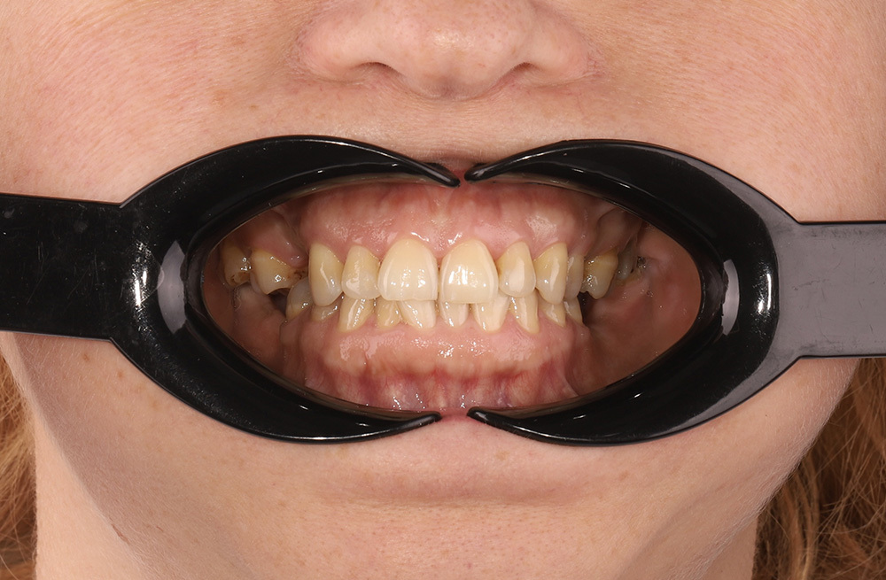 Ортодонтическое лечение с одновременным протезированием для создания идеальной улыбки