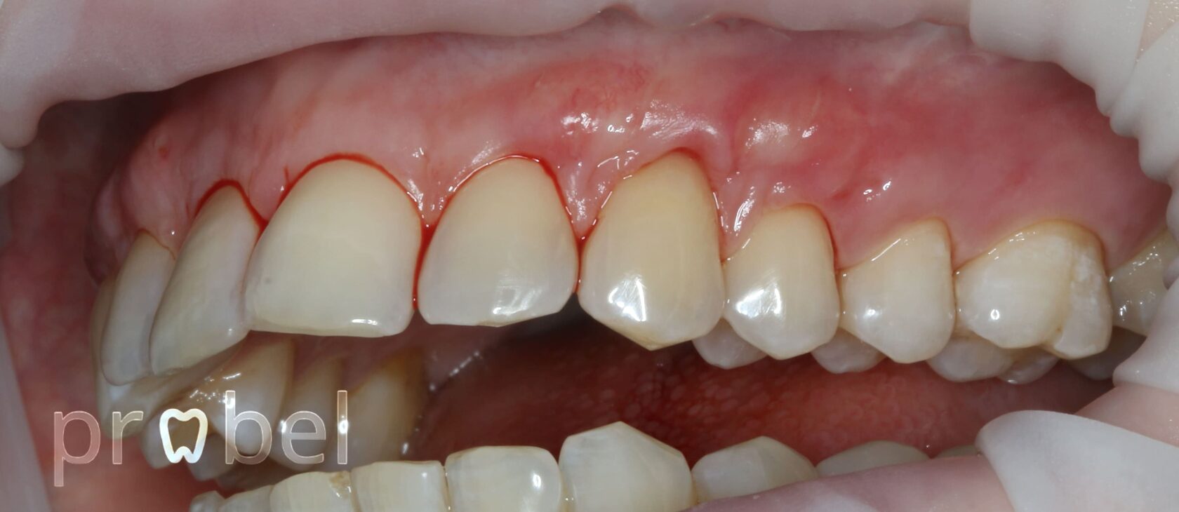 После пластики десны в стоматологии Пробел в Москве ЖК Царская площадь