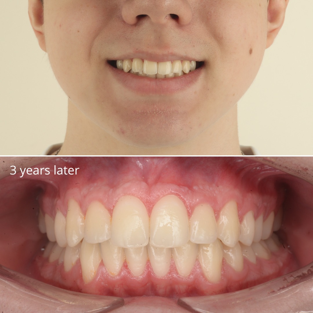 Stage of treatment showing the arch nearing its corrected form — photo 4 of 6