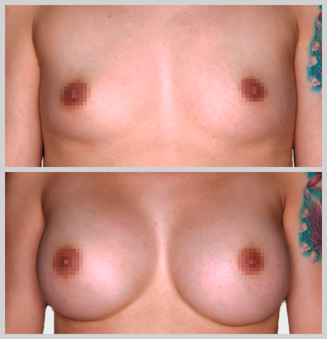 маммопластика увеличение груди импланты