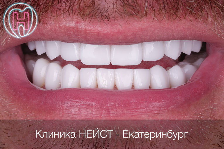 керамические виниры цвет Блич 1 (Bleach 1)