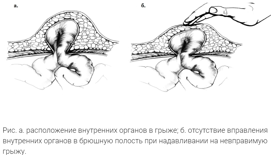 Герниопластика