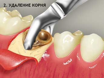 Воспаление корня зуба: симптомы, лечение, профилактика