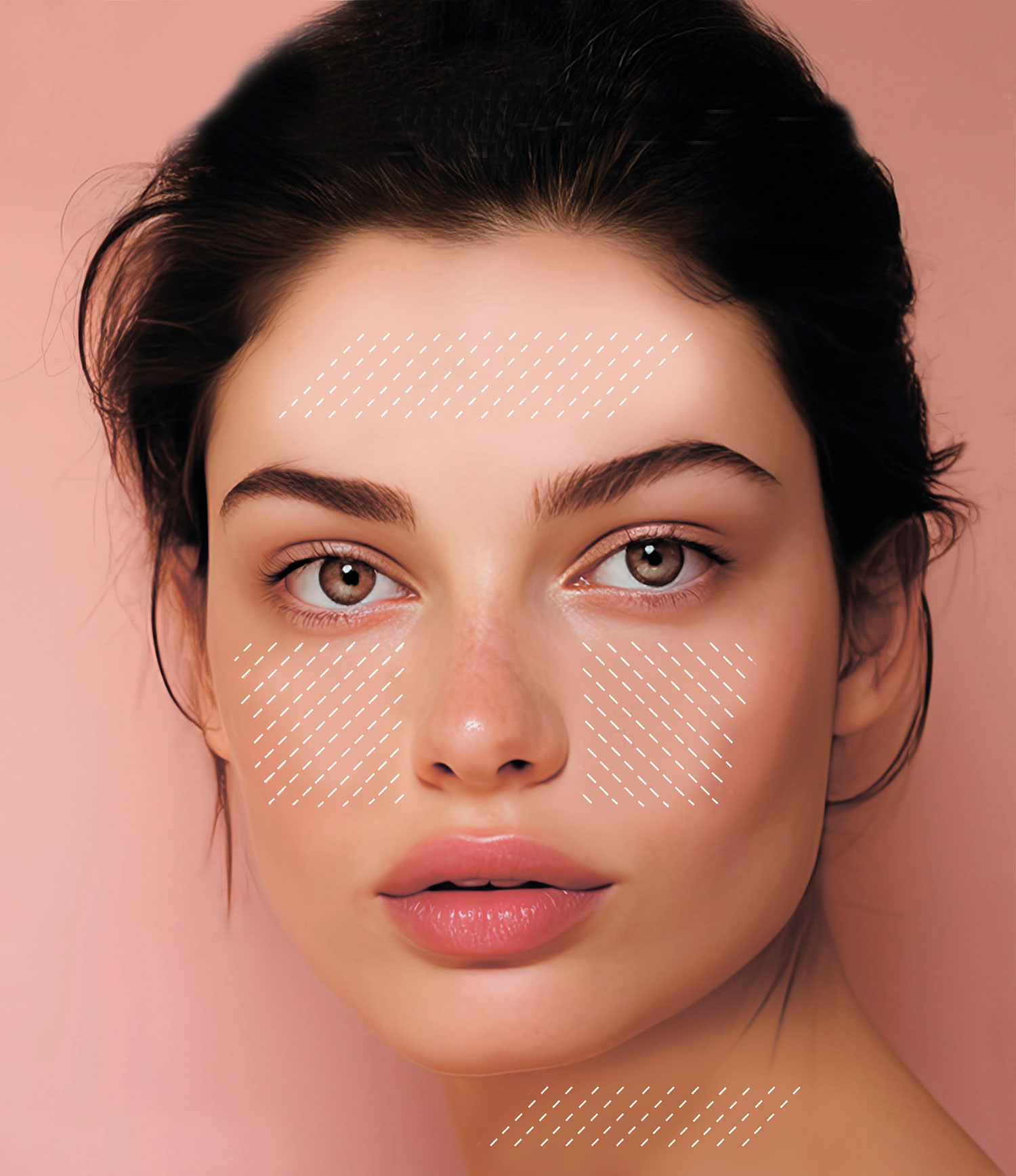 Ultracol - филлер на основе полидиоксанона