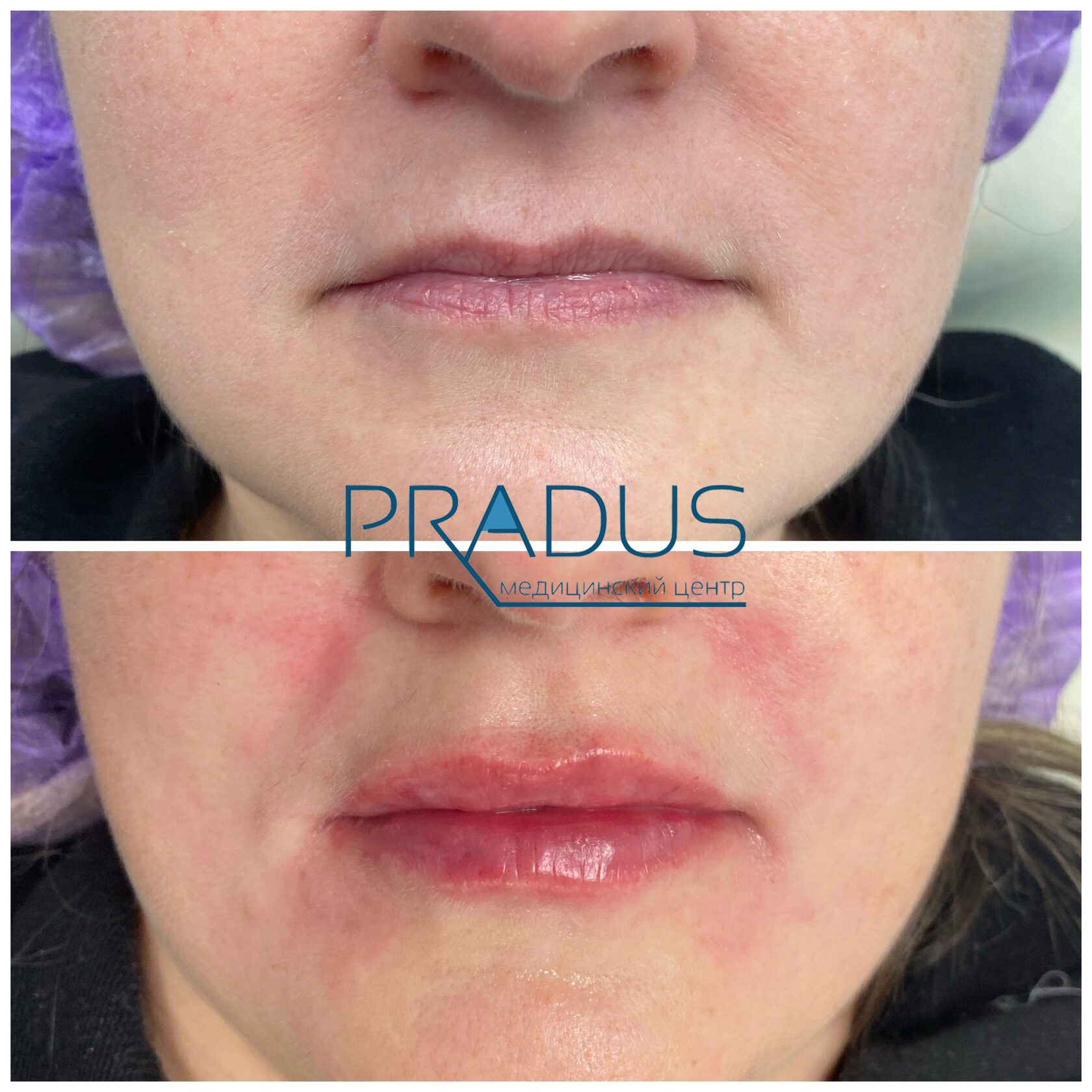 До и после контурной пластики губ. Увеличение объёма без утяжеления. PradusCOSMO, Васильевский остров