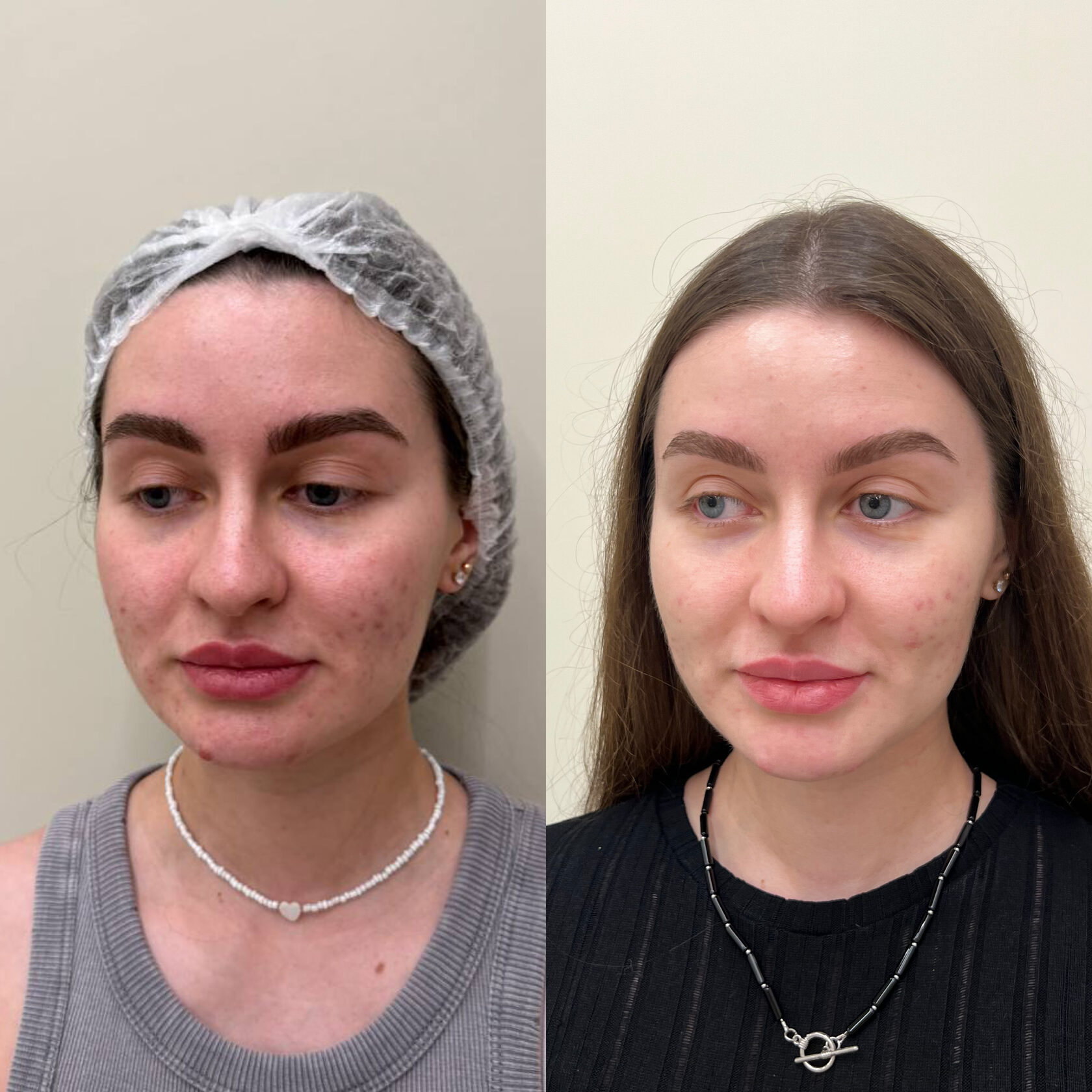 Результат комплекса процедур клиники Skinsense и правильно подобранного домашнего ухода