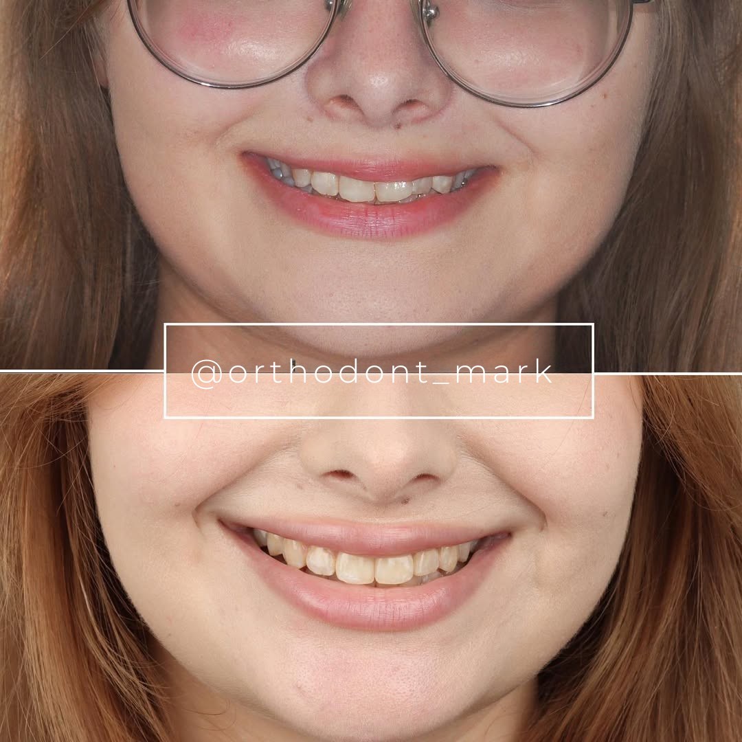 Crowding and Canine Infraposition Resolved into a Symmetric Smile