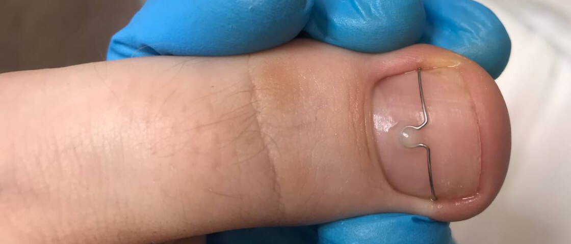 Трещины на ногах, Лечение трещин на ногах, Профилактика трещин, Трещины на пятках, Сухие трещины на ногах, Кровоточат пятки, гбубокие трещины на ногах, трезены с кровью, потемнение трещин, темные трещины на пятках, черные пятки 