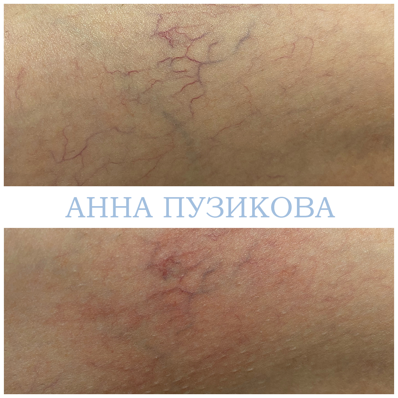 Результат удаления сосудистых звёздочек и купероза на лице с помощью фототерапии ClearLight IPL — врач-косметолог Пузикова Анна Анатольевна, Санкт-Петербург