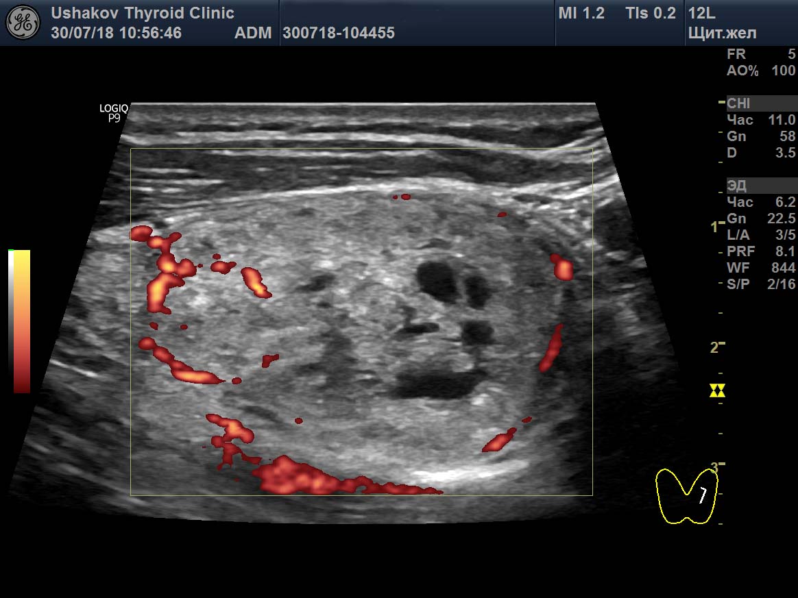 Рак щитовидной железы на узи фото как выглядит