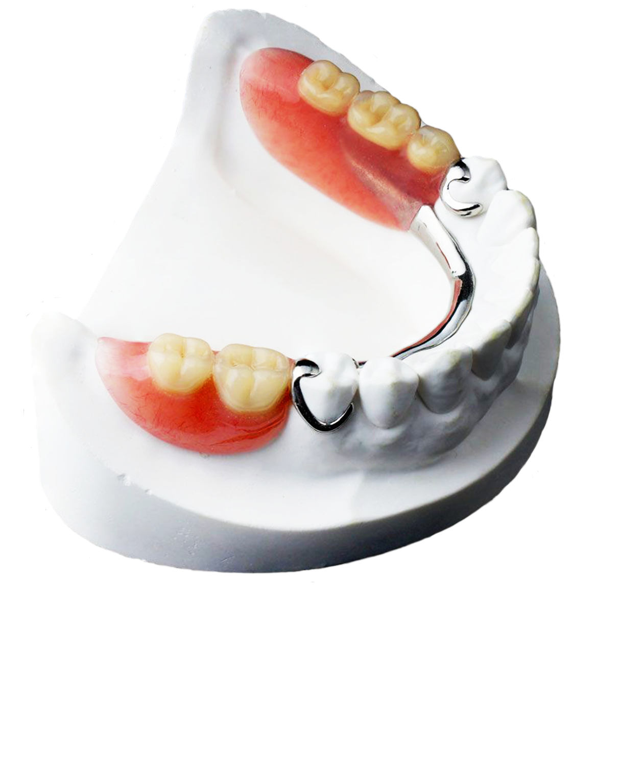Бюгельный протез quattro ti. Бюгельный протез (1 челюсть)+кламмер. Мост зубной бюгельный протез. Бюгельный микропротез на 1 зуб. Как называется протезист