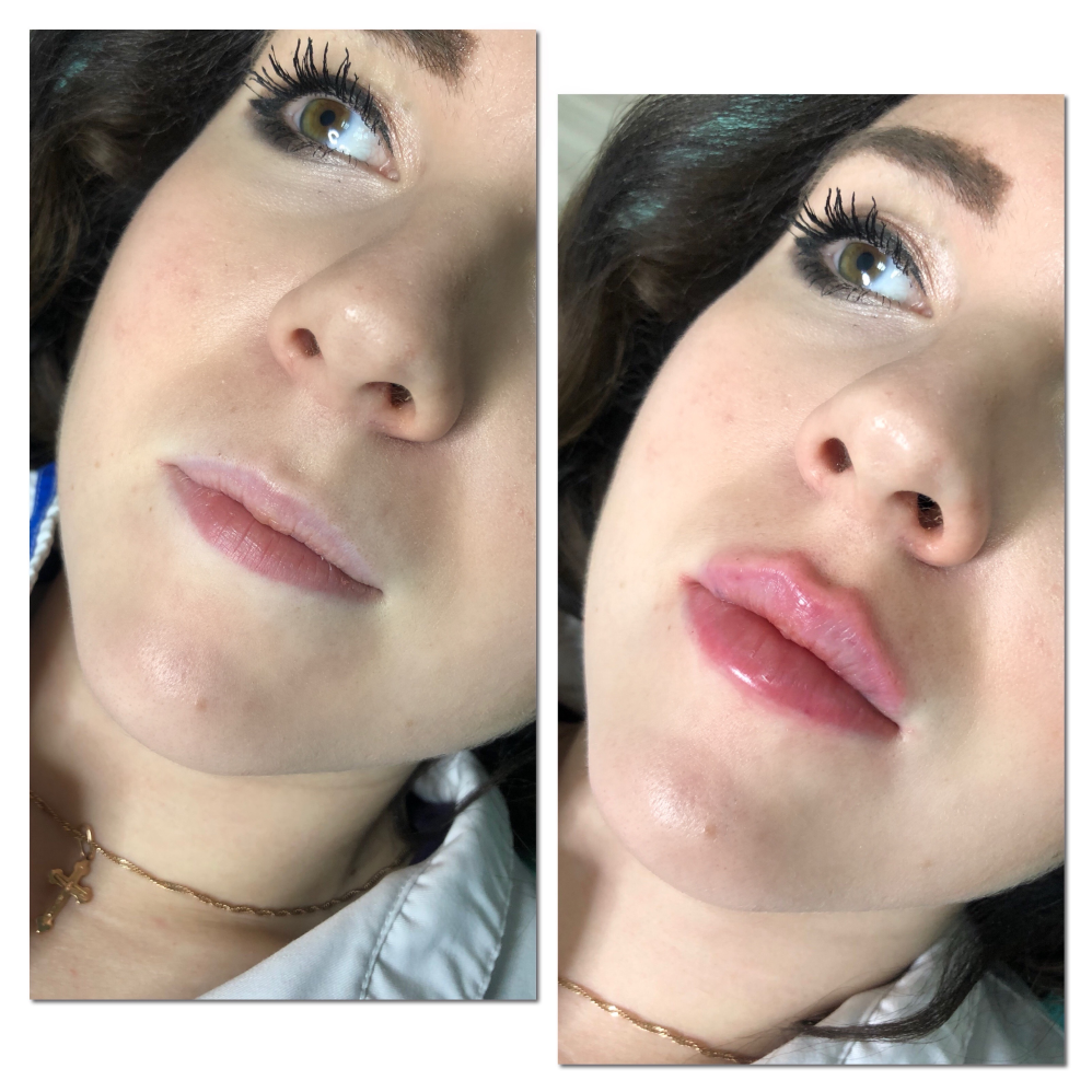 Lip fill. Контурная пластика Revofil. Филоеры для ГУ.